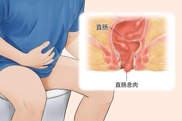 这1种息肉几乎100%会癌变！上厕所或4个提示，别等到肠癌才后悔